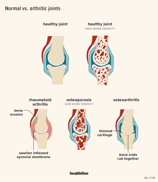 Can You Actually Find a Natural Way to Reverse Arthritis or Is It All Marketing Hype?