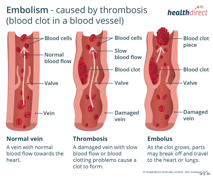 Defining Magnitude in the Lungs: What Is Considered a Large Pulmonary Embolism in Modern Clinical Practice?