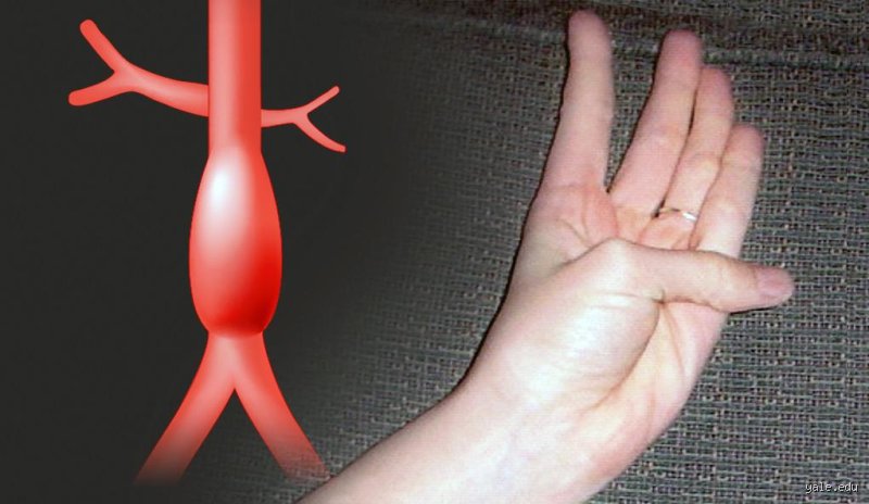 Why a Simple Thumb Test for Aortic Aneurysm Could Save Your Life—And the Medical Debate Surrounding It