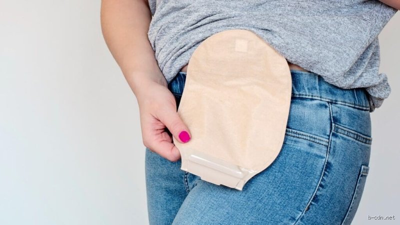 Waking Up with a Urinary Catheter: Why Do You Have to Wear a Bag After Prostate Surgery?