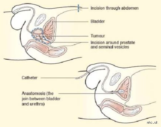 Why does urine smell after prostate surgery?