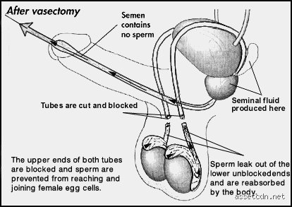Does come still come out after a vasectomy?
