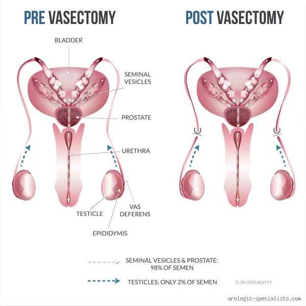 Navigating The Optimal Age For Male Sterilization And Permanent Family Planning Choices