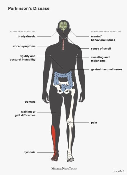 Mapping the Degeneration: What Organ Is Most Affected by Parkinson's Disease and How It Fails