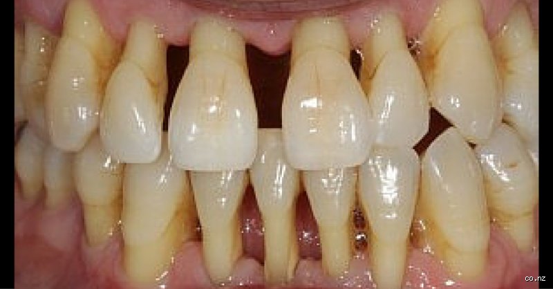 What is the Absolute Worst Thing for Receding Gums? The Unseen Enemy Destroying Your Smile