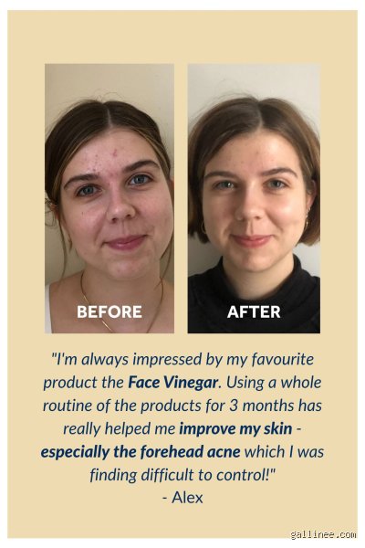Can I Rub White Vinegar on My Skin? The Acidic Truth Behind TikTok’s Favorite DIY Skincare Hack