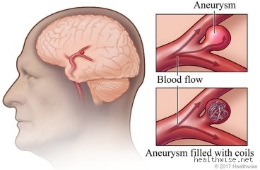 The Silent ticking clock: Can you fix an aneurysm before it ruptures and what are the survival stakes?