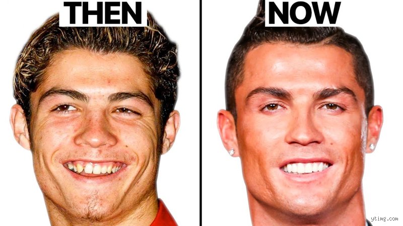 Has CR7 Ever Had Surgery? The Truth Behind Cristiano Ronaldo’s Iconic Physical Transformation