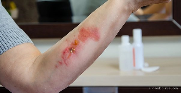 The Burning Truth: How Long Does Acid Burn Heal and What Controls the Clock?
