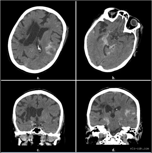 The Shadows in the Brain: What Can Mimic an Aneurysm and Fool the World’s Best Neurologists