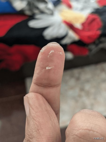 When I Scratch My Scalp, I Get White Stuff in My Nails: Is It Dandruff, Sebum, or Product Buildup?