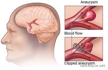 How do they fix a small aneurysm?