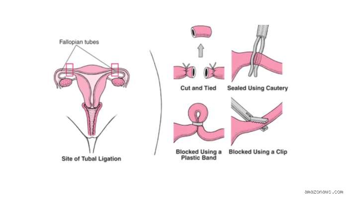 How Painful is Female Sterilisation? The Brutal, Honest Reality Medical Brochures Conveniently Leave Out
