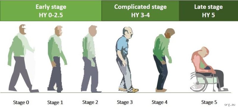 Navigating the Harsh Realities of What Is Stage 5 of Parkinson Disease Today