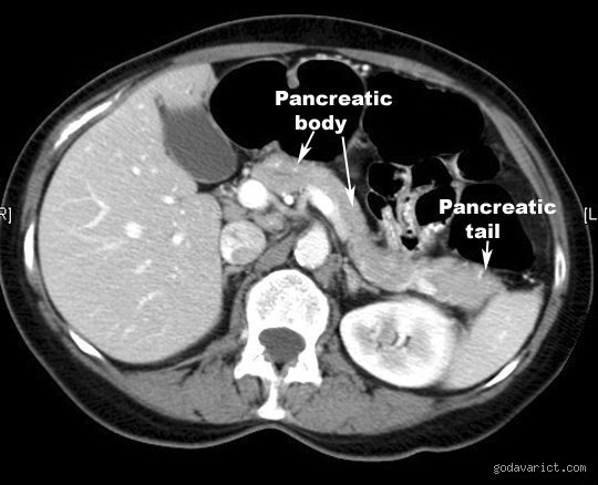 Navigating the Diagnostic Maze: What Is the Best Scan for Pancreatitis in Modern Medicine?