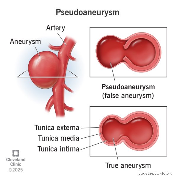 Will a Pseudoaneurysm Go Away on Its Own or Are You Toast? The Grim Reality of Vascular Leaks