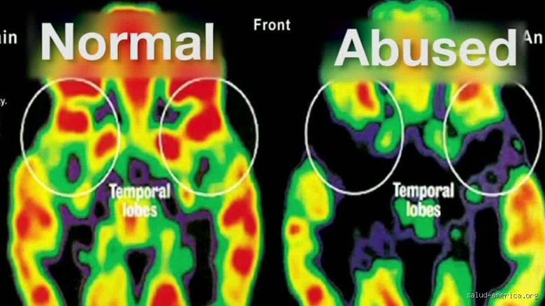 What Does Emotional Abuse Do to Your Brain And How It Silently Rewires Your Mind
