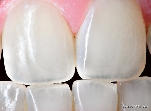 How Do I Know If My Enamel Is Completely Gone? The Definitive Guide to Tooth Erosion