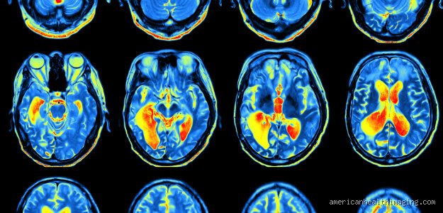 Looking Inside the Hyperactive Mind: Can You See ADHD on a Brain Scan Right Now?
