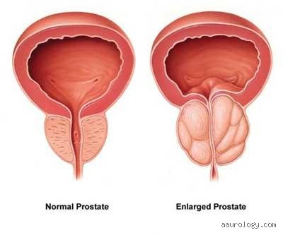 What worsens an enlarged prostate?