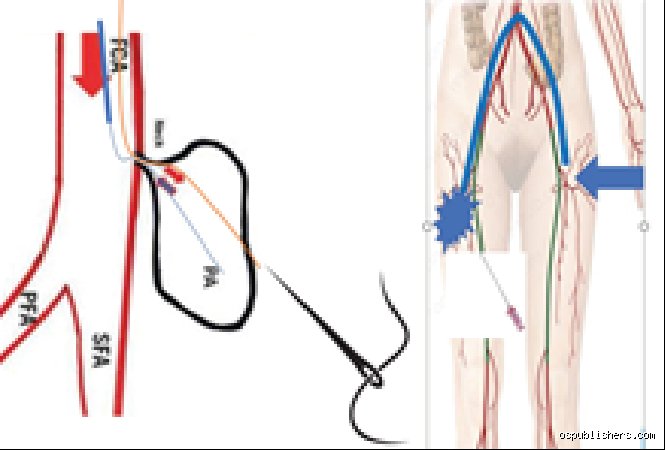 How to Repair a Femoral Pseudoaneurysm: Advanced Clinical Strategies and Surgical Techniques
