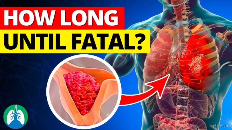 The Invisible Countdown: How Long Before a Pulmonary Embolism Becomes Fatal and Saves or Claims a Life