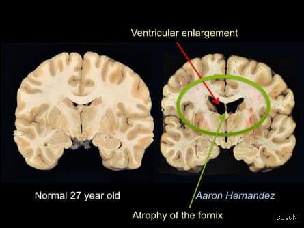 The Tragic Scale of Brain Trauma: Who Has the Worst CTE Recorded in Medical History?