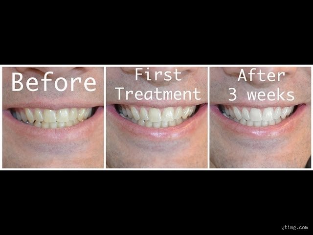 How Long Does Hydrogen Peroxide Take to Lighten Teeth? The Real Timeline Revealed