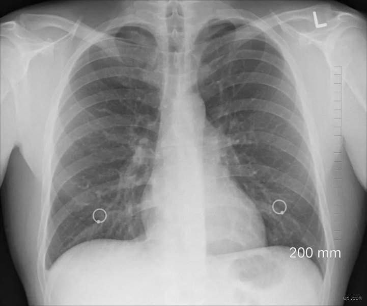 Can Your Lungs Clear Asbestos? The Grim Reality Behind Fibers That Refuse to Leave