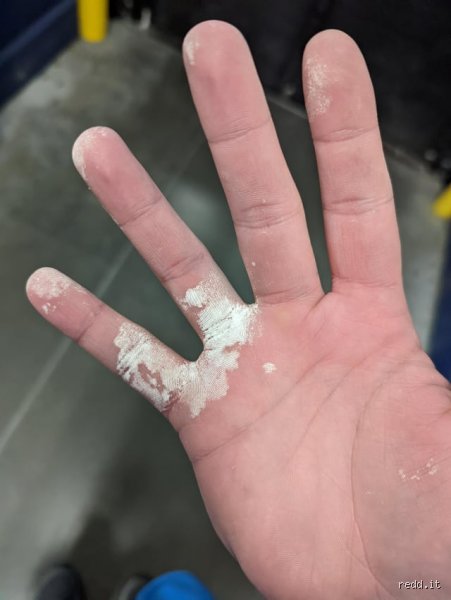 Does peracetic acid melt skin or just cause severe chemical burns?