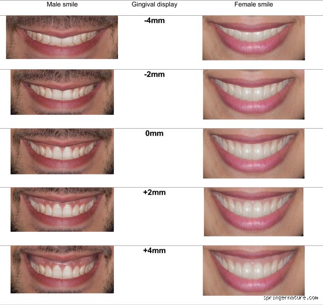 Is showing teeth attractive or just an awkward social reflex we overanalyze