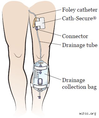 Do You Have to Wear a Bag After Prostate Removal? Separating Surgical Myths From Modern Post-Op Reality