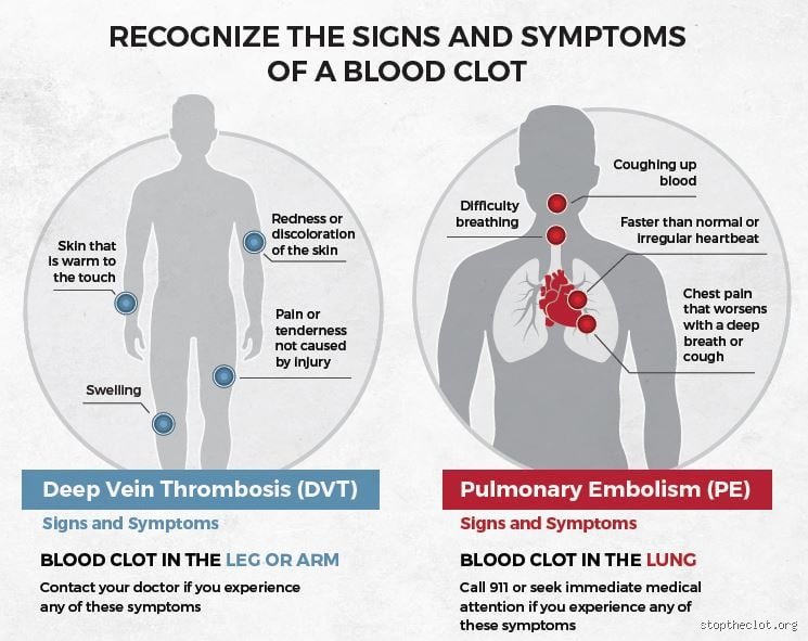 Is PE the Same as a Blood Clot? Demystifying the Deadly Relationship and What You Must Know
