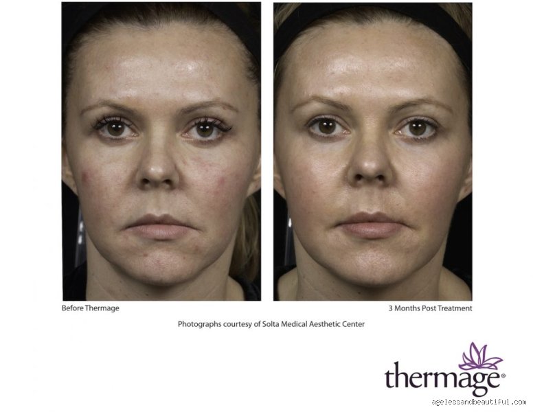 Does B12 deficiency cause wrinkles on the face and accelerate skin aging?