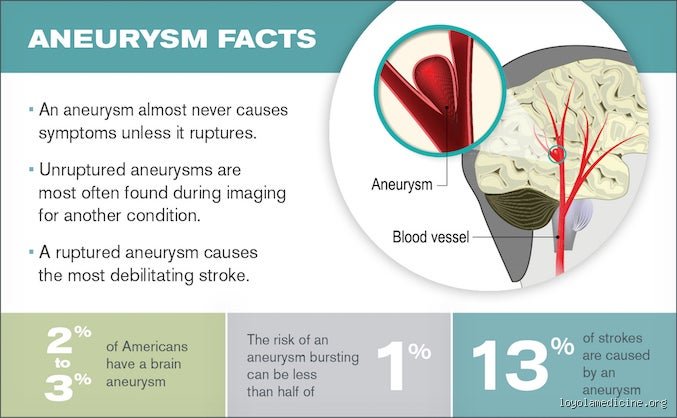 When to Worry About a Brain Aneurysm: The Unspoken Reality of the Ticking Time Bomb in Your Head