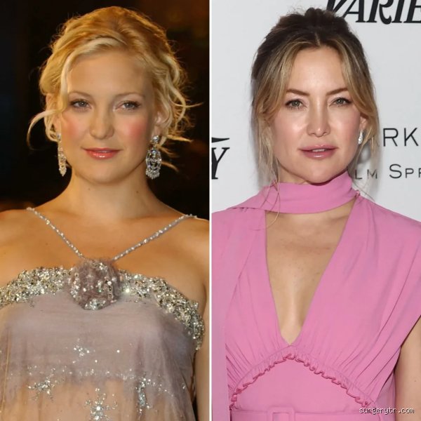 Decoding the Transformation: What Did Kate Hudson Have Done to Her Face and Why It Matters Now