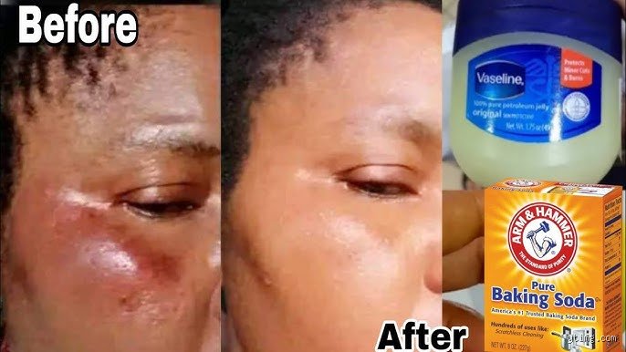 What Do Vaseline and Baking Soda Do for Your Skin? Separating Social Media Hype From Actual Dermatological Science