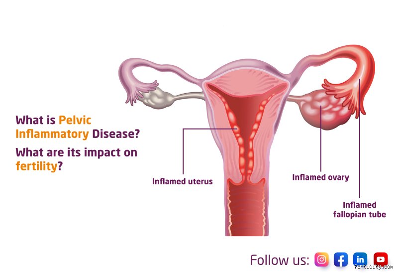 Can Pelvic Inflammatory Disease Affect Sperm And Male Fertility Dynamics