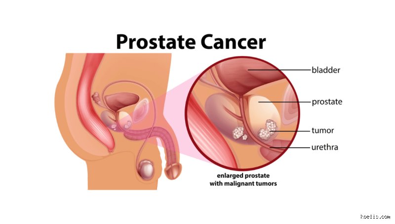 Understanding the True Impact and Long Term Side Effects of Having Your Prostate Removed